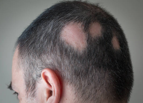 Hair Loss Treatments in Abu Dhabi