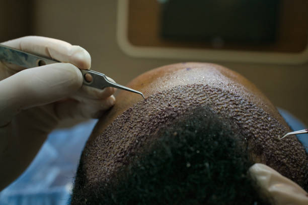 hair transplant in Abu Dhabi