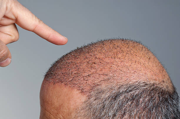 Hair Transplant in Abu Dhabi