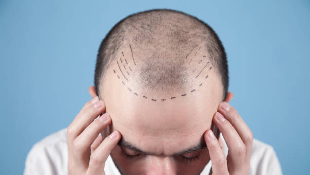 Hair Transplant in Abu Dhabi