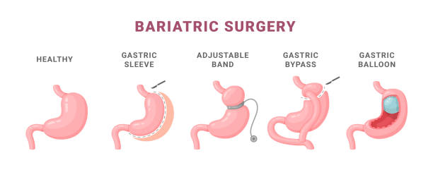 Bariatric Surgery in Abu Dhabi