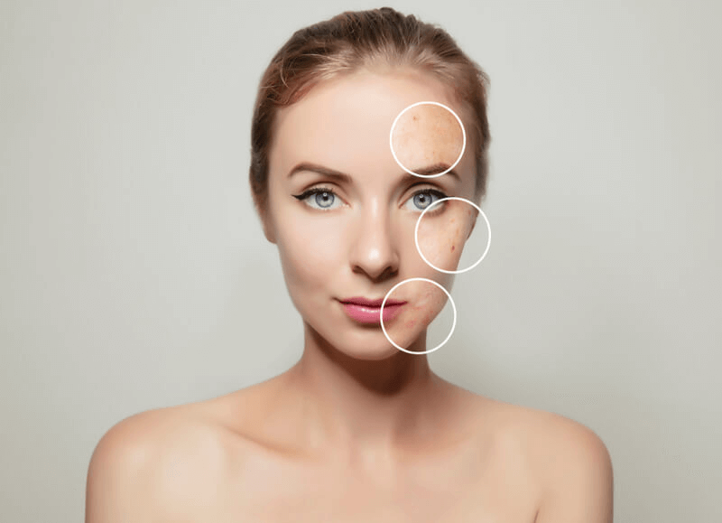 Pico Laser Treatment in dubai