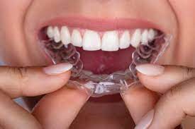 Invisalign Braces Treatment Cost in Dubai