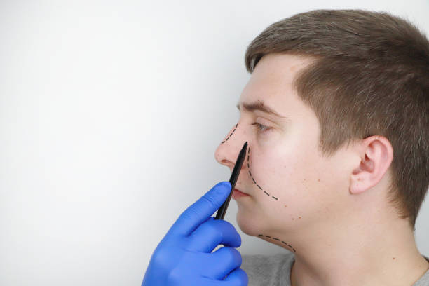 rhinoplasty in Al Ain