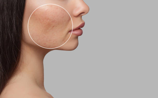 acne treatment in Abu Dhabi