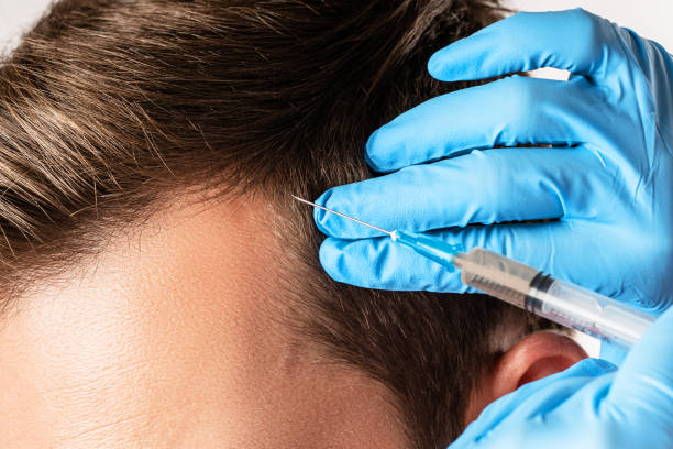 PRP Hair Treatment in Abu Dhabi.