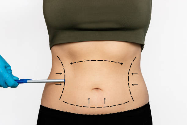 liposuction in Abu Dhabi