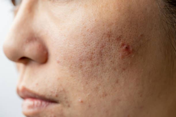 acne treatment in Abu Dhabi