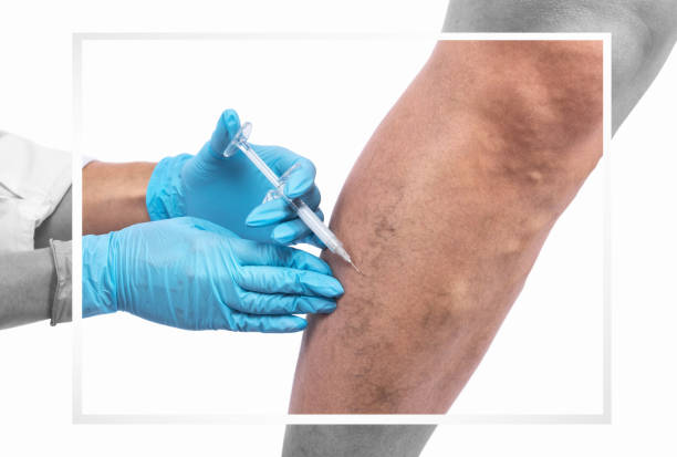 Sclerotherapy in Al Ain