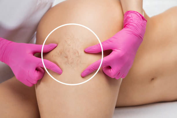 cellulite removal treatment in Abu Dhabi