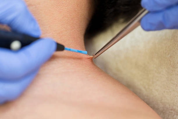 Skin Warts Removal Clinic in Abu Dhabi