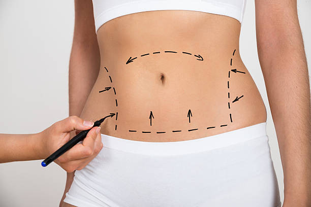 Liposuction Abu Dhabi