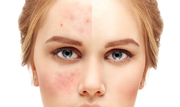 Rosacea Treatment in Abu Dhabi