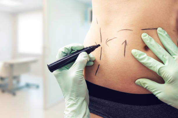 liposuction in Abu Dhabi