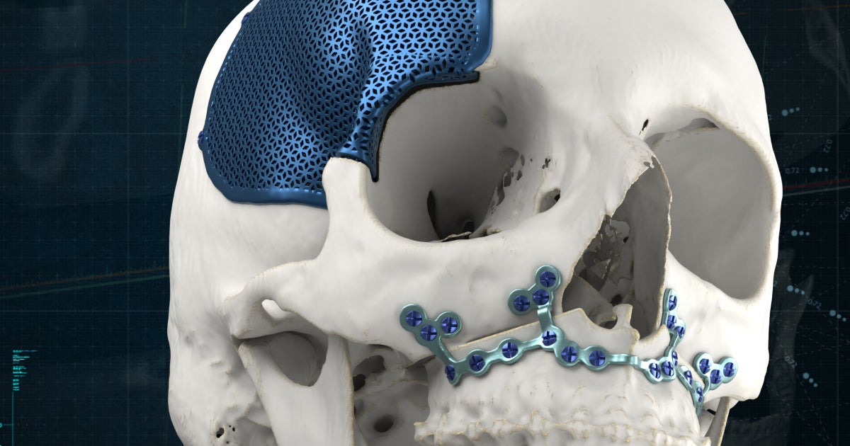 Global Craniomaxillofacial Implants Market