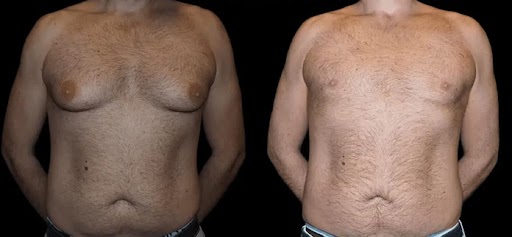 before and after male breast reduction results.