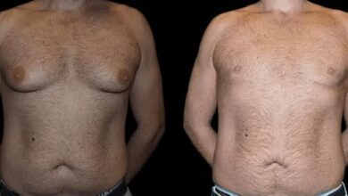 before and after male breast reduction results