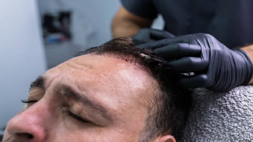 PRP Hair Treatment Cost in Abu Dhabi