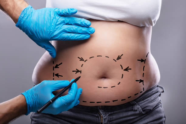 Vaser 4D liposuction in Abu Dhabi