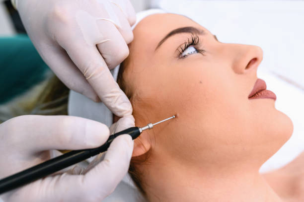 Mole Removal Treatments in Abu Dhabi