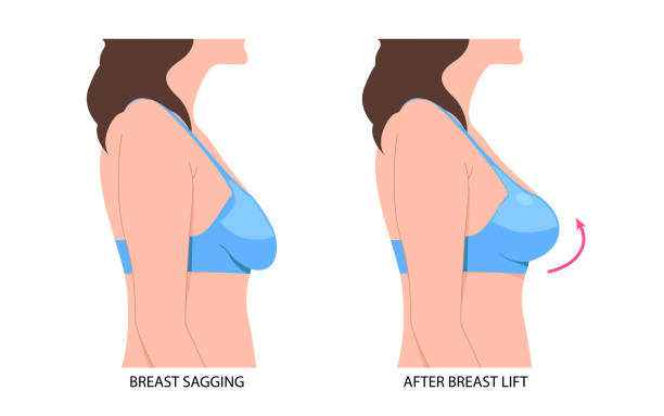 breast lift in Abu Dhabi